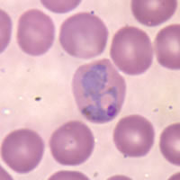 Example of the Malaria parasite, Plasmodium vivax in a human red blood cell