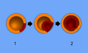 1 - Blastula; 2 - Gastrula; Ectoderm is orange, endoderm is red.